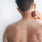 Bangladesh Measles