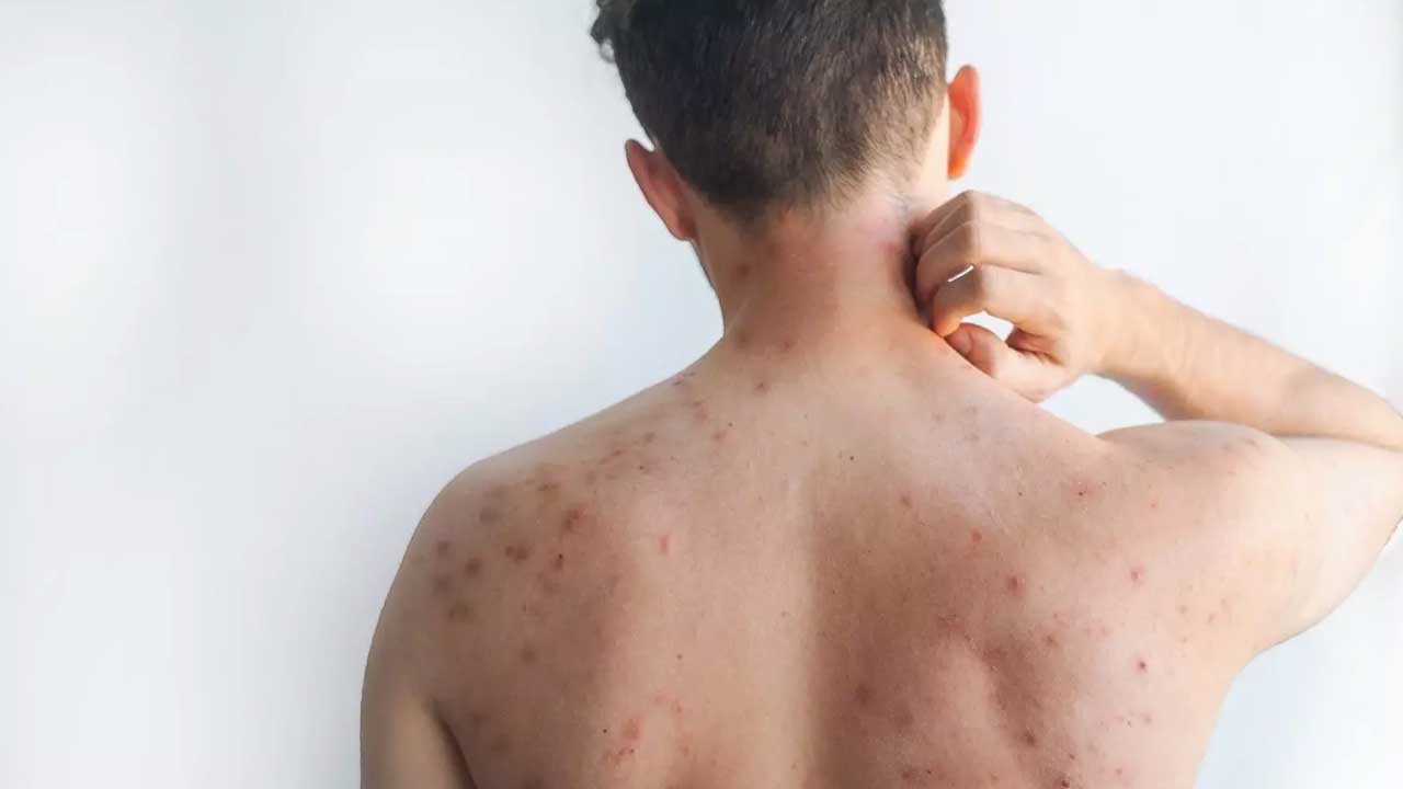 Bangladesh Measles