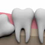 Wisdom Teeth Problems