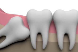 Wisdom Teeth Problems