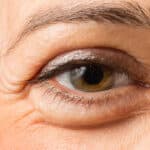 Morning Eye Swelling