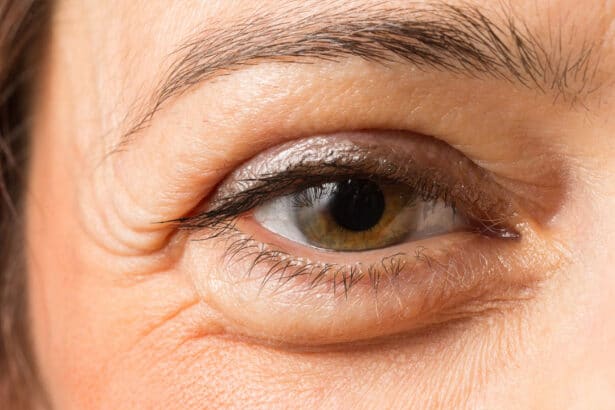 Morning Eye Swelling